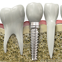 Dental Implants Calgary NE