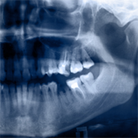 Dental Digital X-rays in Calgary NE