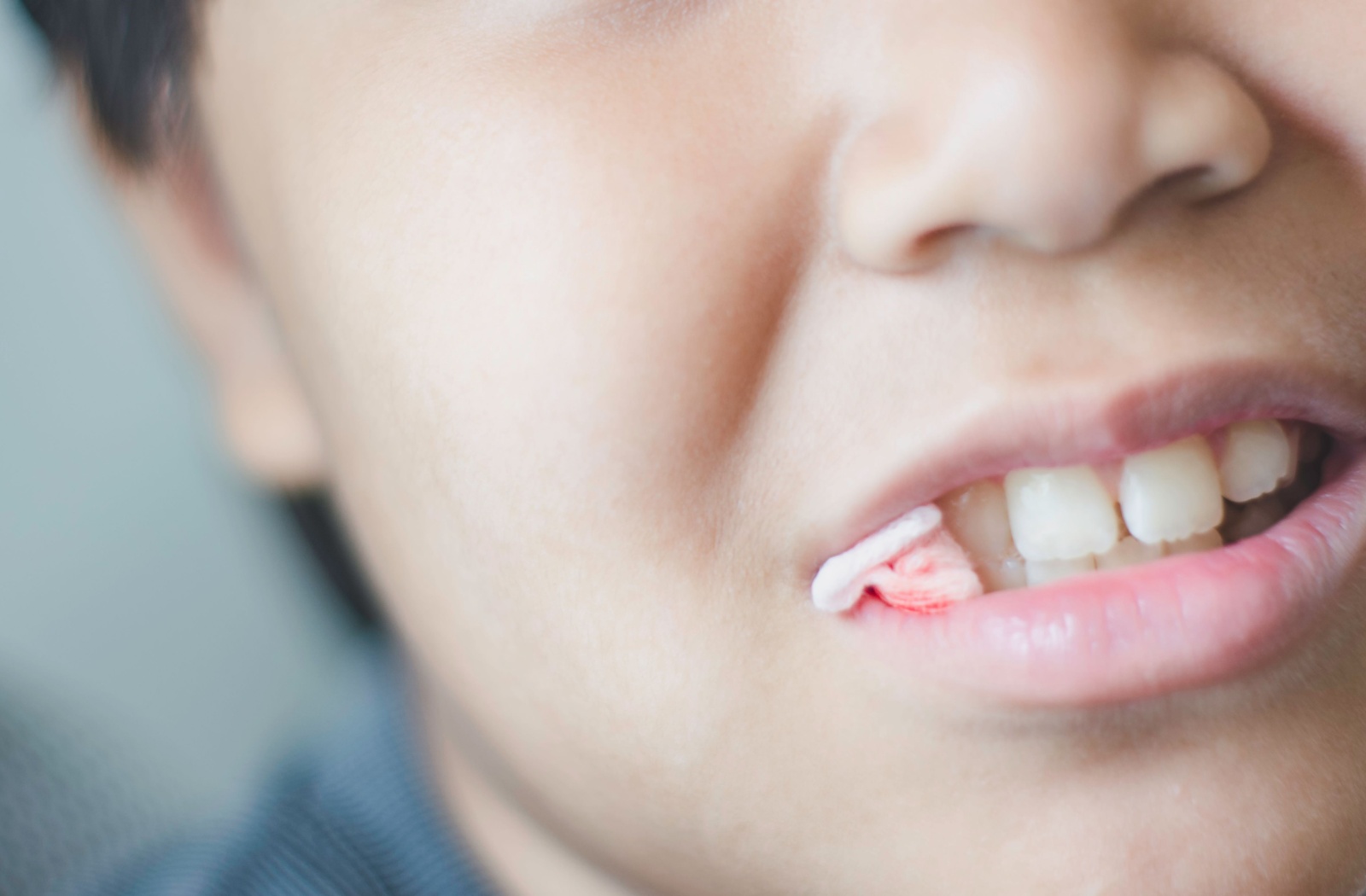 A child with gauze in his mouth