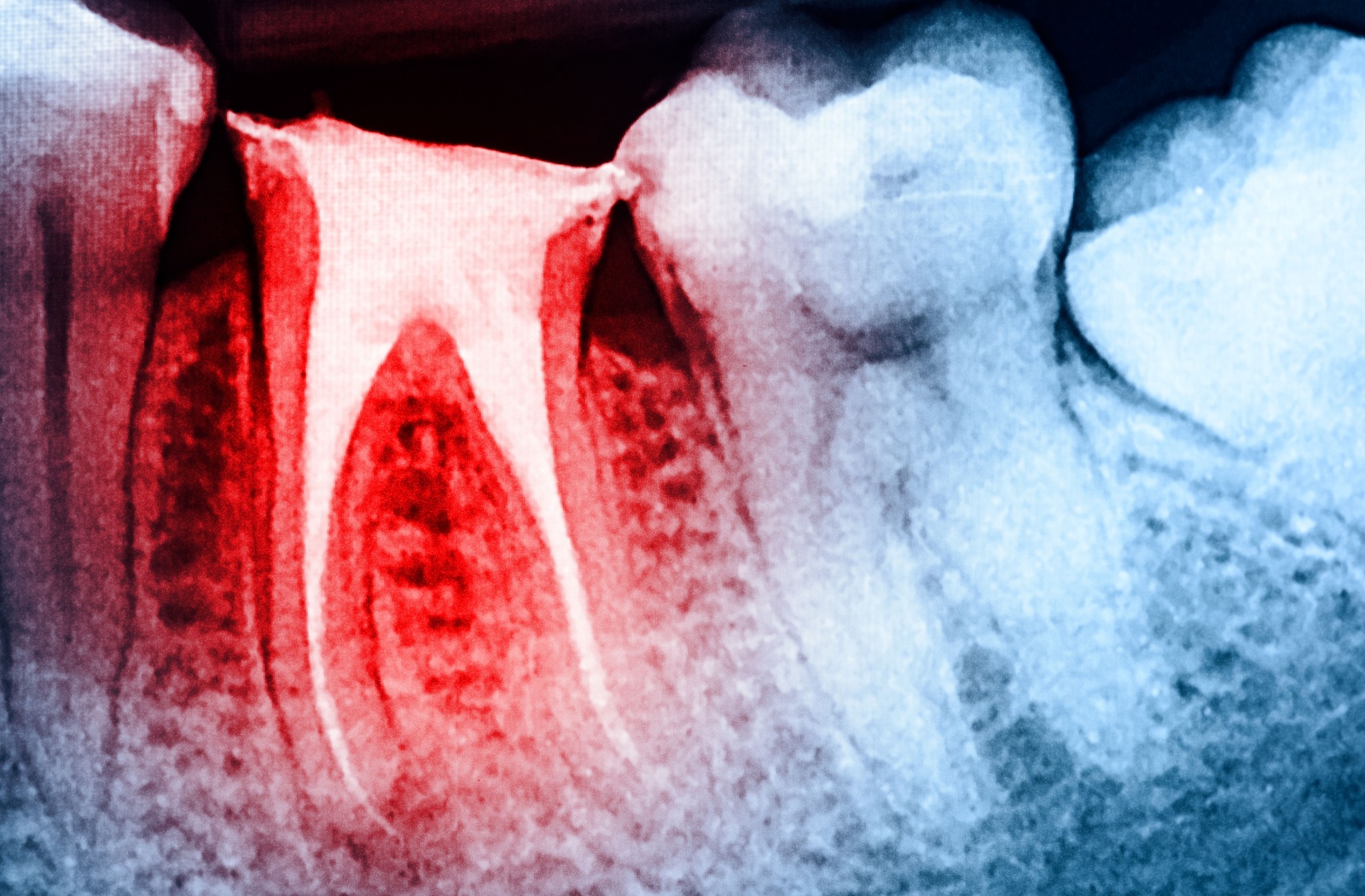 An x-ray of teeth that shows a situation where a root canal is needed